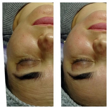 Мультифункціональний пілінг "Інста лук"
                    Косметологічний центр WE Cosmetology Одеса