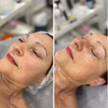 Мезоліфтинг пілінг ALL-Q
                    Косметологический центр WE Cosmetology Одесса