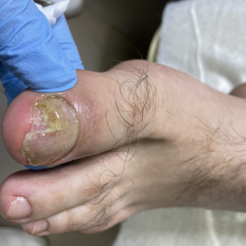 Комплексне мікологічне дослідження (аналіз на грибкові захворювання нігтів та стопи)
                    Подолог Наталія Киев