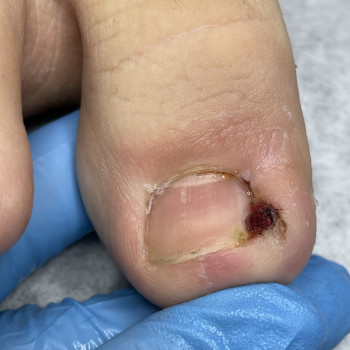 Лікування врослого нігтя
                    Подолог Наталія Киев