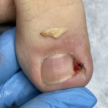 Лікування врослого нігтя
                    Подолог Наталія Киев