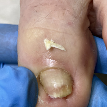 Лікування врослого нігтя
                    Подолог Наталія Киев