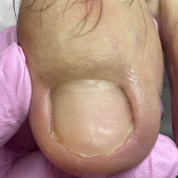 Лікування врослого нігтя
                    Подолог Наталія Киев