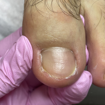 Лікування врослого нігтя
                    Подолог Наталія Киев