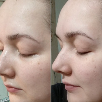 Альгінатна маска Освітлення для обличчя, або обличчя, шиї, декольте
                    Косметологический центр WE Cosmetology Одесса