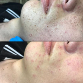 Комбінована чистка обличчя (апаратна+механічна+догляд)
                    Косметологический центр WE Cosmetology Киев