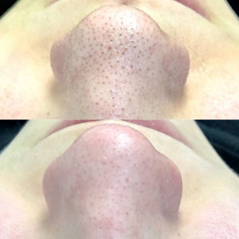 Комбінована чистка обличчя (апаратна+механічна+догляд)
                    Косметологический центр WE Cosmetology Киев