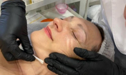 Мезоліфтинг пілінг ALL-Q Косметологічний центр WE Cosmetology Київ