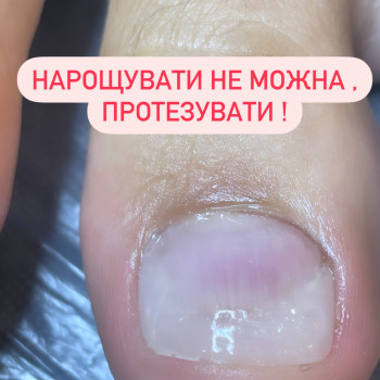 Протезування нігтьової пластини медичним гелем
                    Подолог Наталія Київ