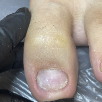 Протезування нігтьової пластини медичним гелем
                    Подолог Наталія Київ