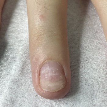 Протезування нігтьової пластини медичним гелем
                    Подолог Наталія Київ