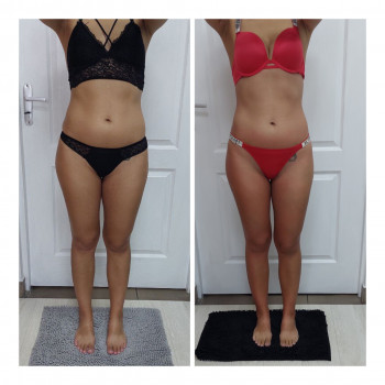 LPG Body Aesthetics, Бровари Фото - 20