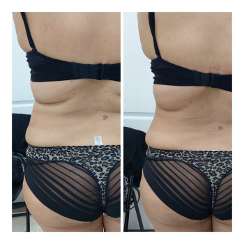 LPG Body Aesthetics, Бровари Фото - 36