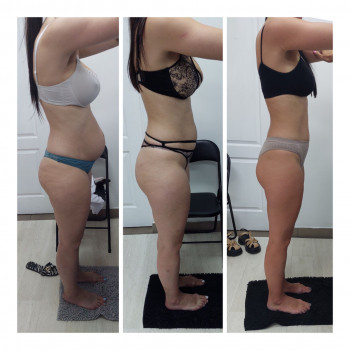 LPG Body Aesthetics, Бровари Фото - 48