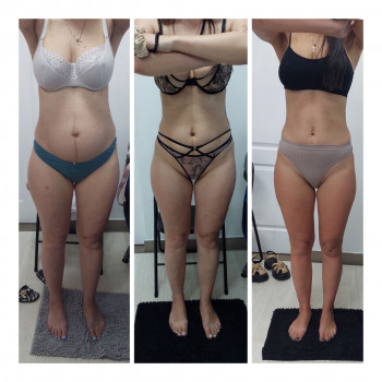 LPG Body Aesthetics, Бровари Фото - 50