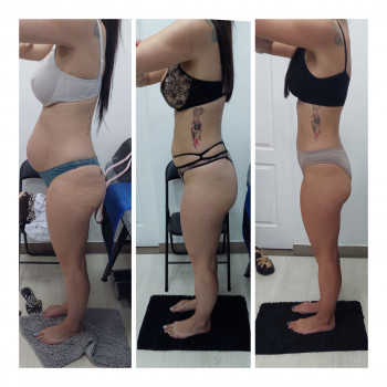 LPG Body Aesthetics, Бровари Фото - 54