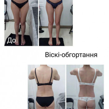 LPG Body Aesthetics, Бровари Фото - 64