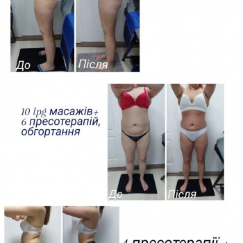 LPG Body Aesthetics, Бровари Фото - 68