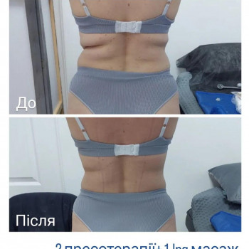 LPG Body Aesthetics, Бровари Фото - 71