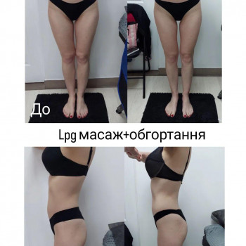 LPG Body Aesthetics, Бровари Фото - 75