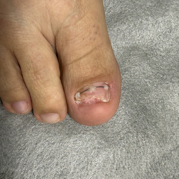 Титановая нить, фото - подолог Татьяна Вакула