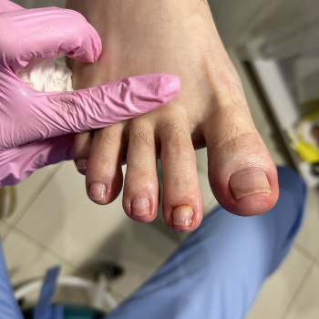 Фото из портфолио специалиста Татьяна Вакула (подолог, Харьков)