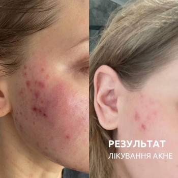 Лікування акне , косметологічні процедури для лікування та правильний підбір домашнього догляду