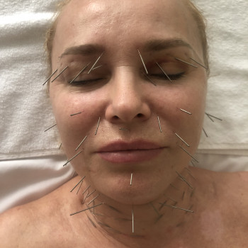 Face Lifting Acupuncture (голки)
                    Масажист Николай Київ