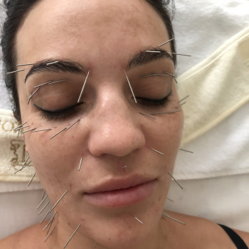 Face Lifting Acupuncture (голки)
                    Масажист Николай Київ