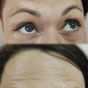 Ботокс чоло