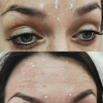 Ботокс чоло