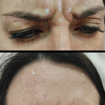 Ботокс межбрівка