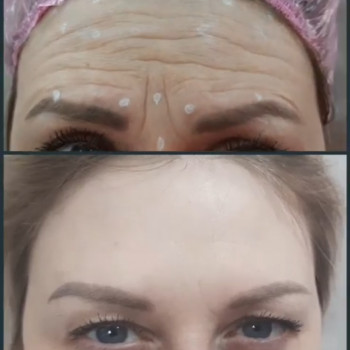 Ботокс чоло
