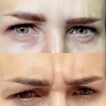 Ботокс межбрівка