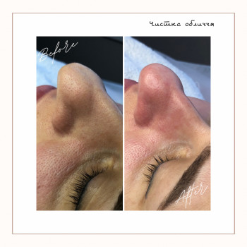 Механічна чистка