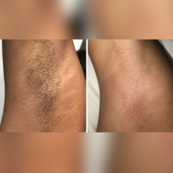 Лазерна Епіляція
                    Салон краси Laser Impuls Київ