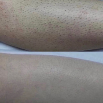 Лазерна Епіляція
                    Салон краси Laser Impuls Київ