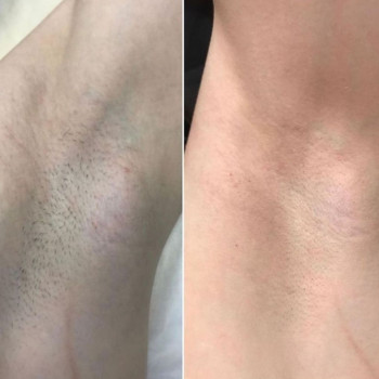 Лазерна Епіляція
                    Салон краси Laser Impuls Київ