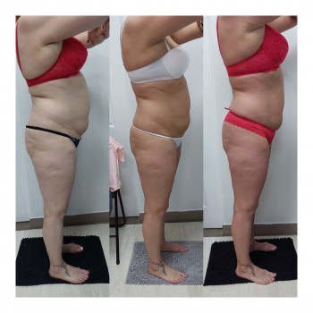 LPG Body Aesthetics, Бровари Фото - 23