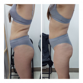 LPG Body Aesthetics, Бровари Фото - 28