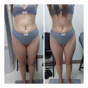 LPG Body Aesthetics, Бровари Фото - 38