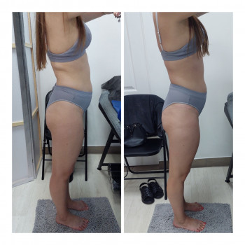 LPG Body Aesthetics, Бровари Фото - 42