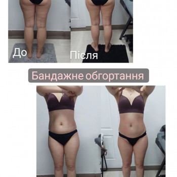 LPG Body Aesthetics, Бровари Фото - 46