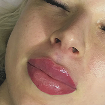 Контурна пластика губ
                    Косметолог-ін'єкціоніст Марина Дніпро