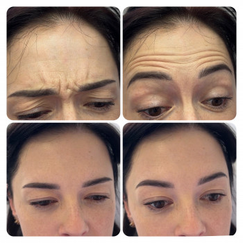 Результат ботудінотерапії через 2 тижні.