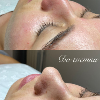 Результат чистки обличчя