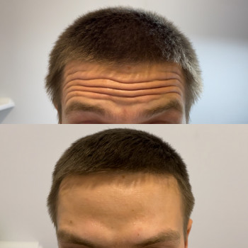 Результат після ботулінотерапії.

   