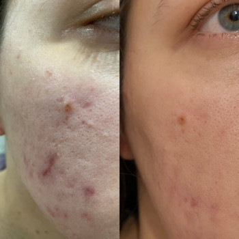 Азелаїновий фітопілінг 30%
                    Косметологический центр WE Cosmetology Одесса
