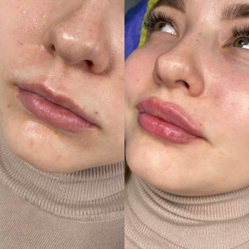 Збільшення губ
                    Косметолог Мария Полтава