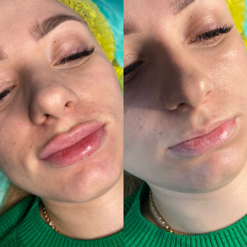 Збільшення губ
                    Косметолог Мария Полтава